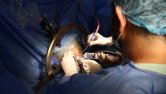 Cirugía exitosa a paciente con Parkinson en Coneuro